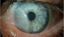 Surgical Technique for Recurrent Pterygium