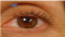 Recurrent Corneal Erosion